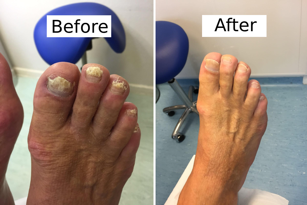 Olumia™ Nail Fungus Oil